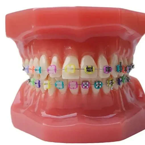 Bracket colorati per pazienti pediatrici