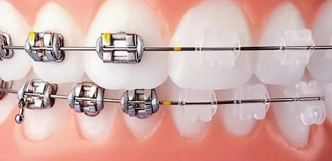 Brackets in metallo e ceramica per ortodonzia