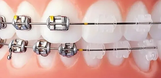 Brackets in metallo e ceramica per ortodonzia